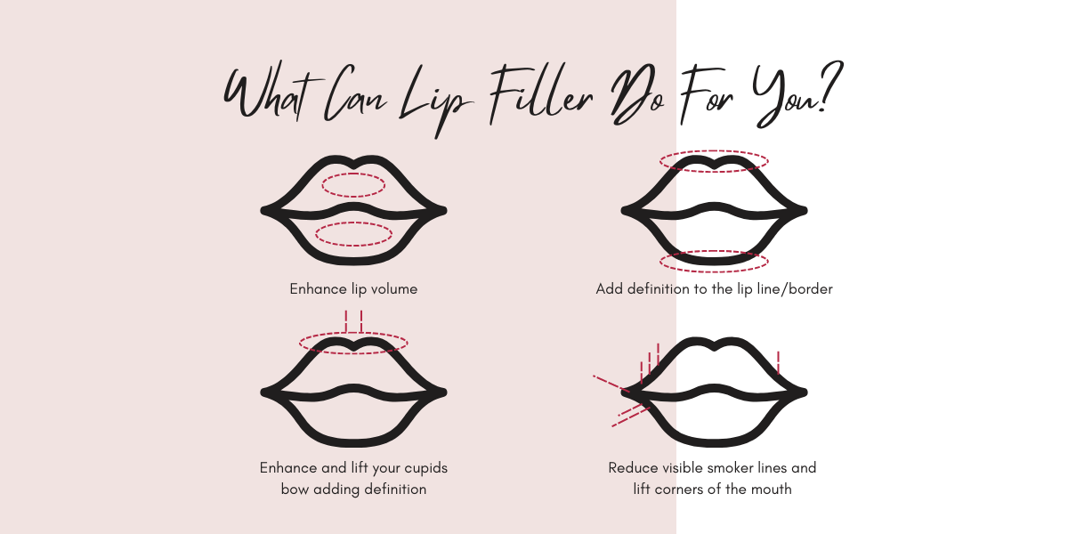 What can lip filler do for you? In York.
Enhance lip volume, add definition to the lip line/border, enhance and lift your cupids bow adding definition and reduce the visible smoker line and lift corners of the mouth 