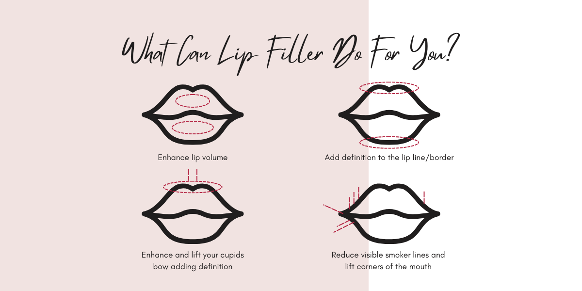 What can lip filler do for you? In York. Enhance lip volume, add definition to the lip line/border, enhance and lift your cupids bow adding definition and reduce the visible smoker line and lift corners of the mouth 