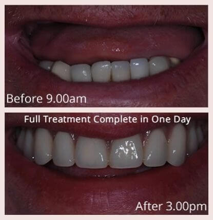 Full Set of Missing Teeth at Blossom Cosmetic Clinic
