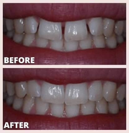 Clear Braces York | Invisalign at Blossom Cosmetic Clinic