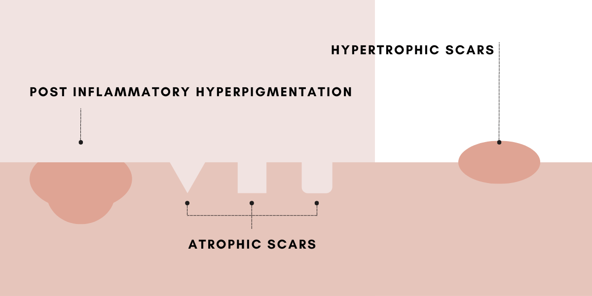 Types of acne scarring post inflammatory hyperpigmentation, atrophic scars and hypertrophic scars - Blossom Cosmetic Clinic in York
