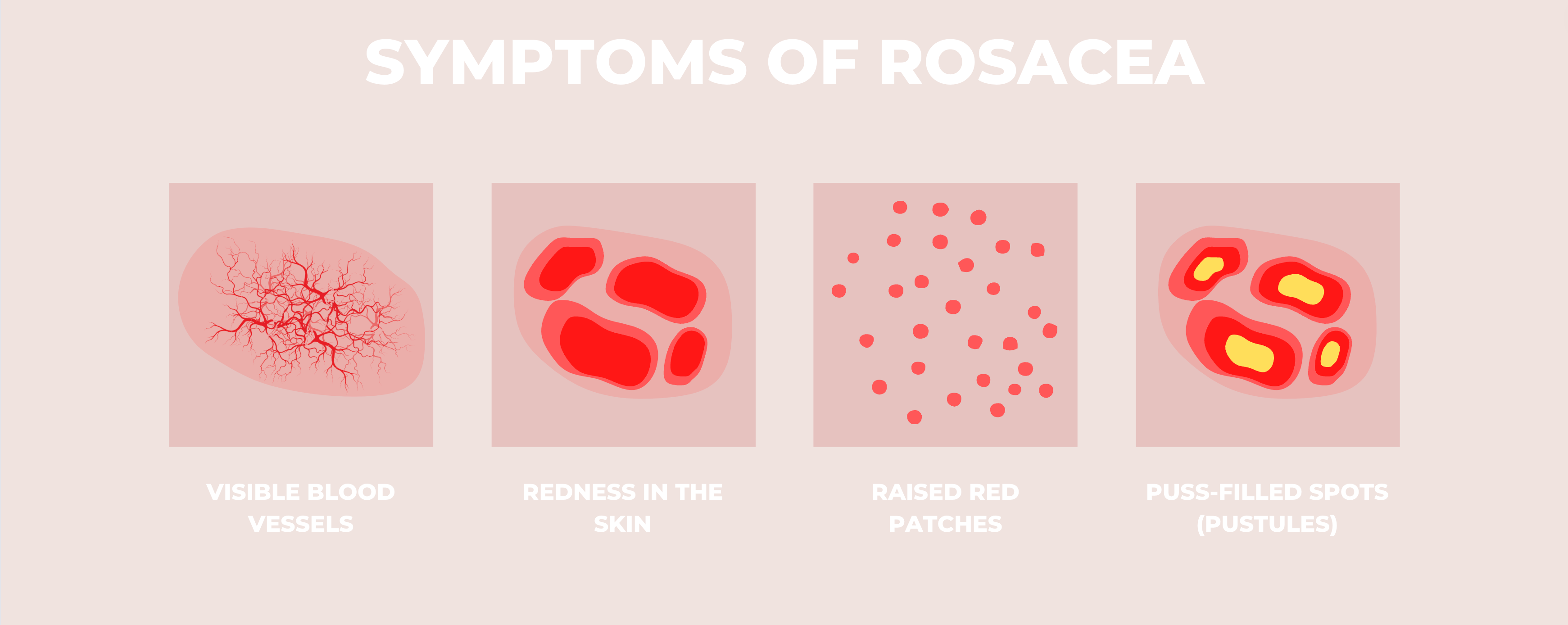 Symptoms of Rosacea infographic. 