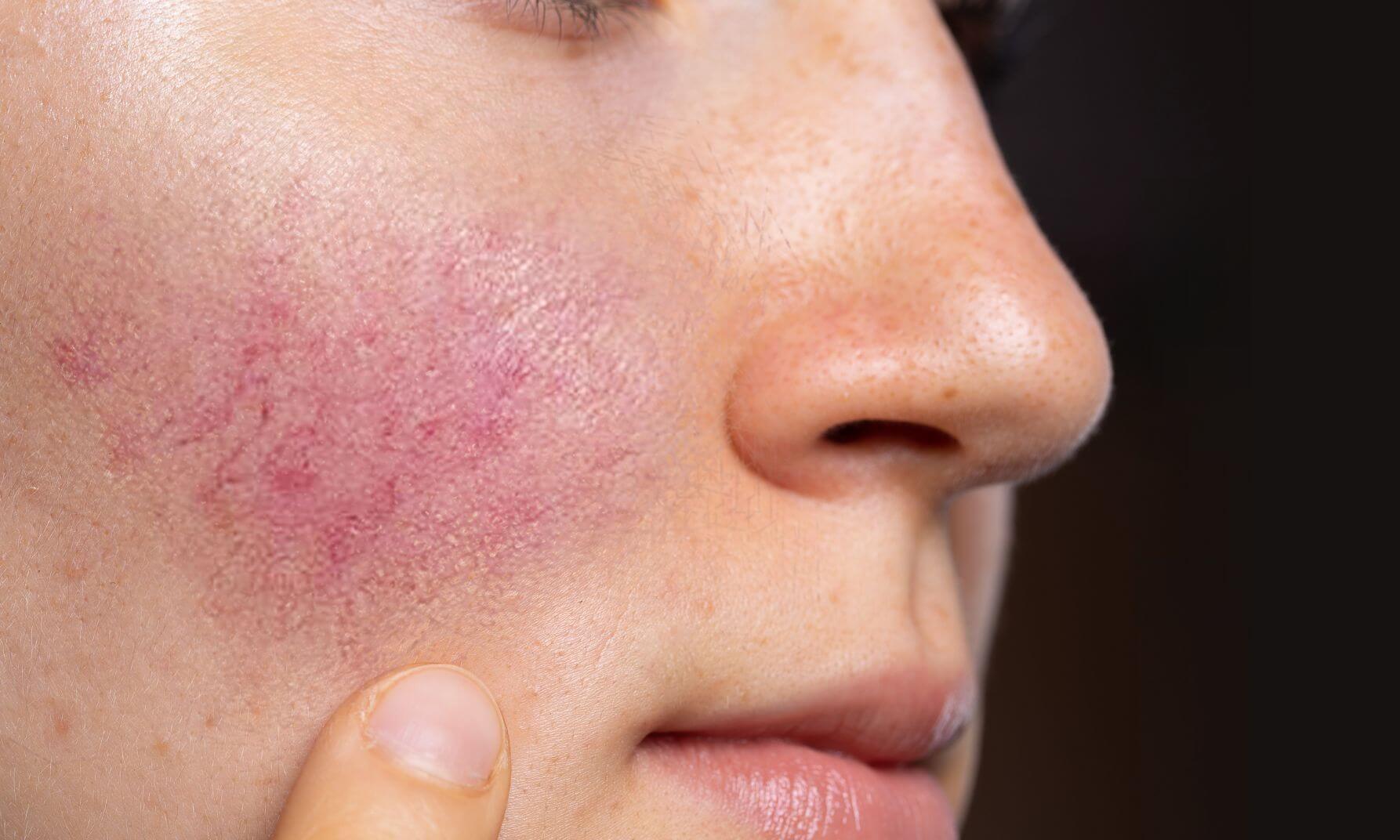 a close up of someone’s face with a red rosacea rash at our York skin clinic