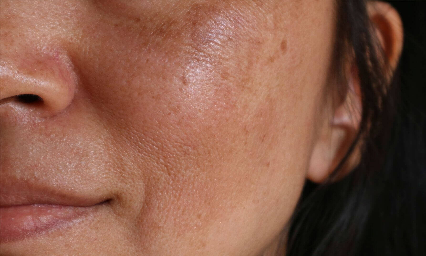 Hyperpigmentation: Types, Treatments & Causes