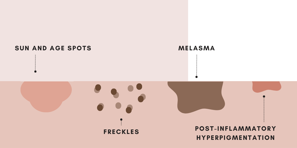Different types of hyperpigmentation. Sun and age spots, freckles, melasma and post-inflammatory hyperpigmentation - Blossom Cosmetic Clinic in York