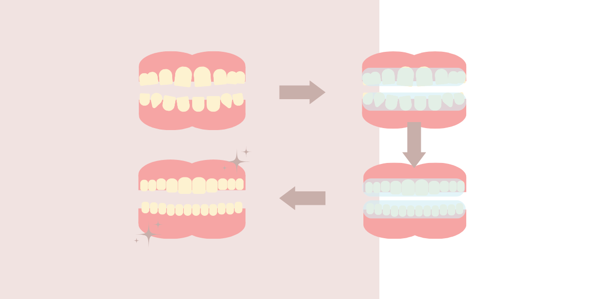 Invisalign before, during and after process at Blossom Cosmetic Clinic in York