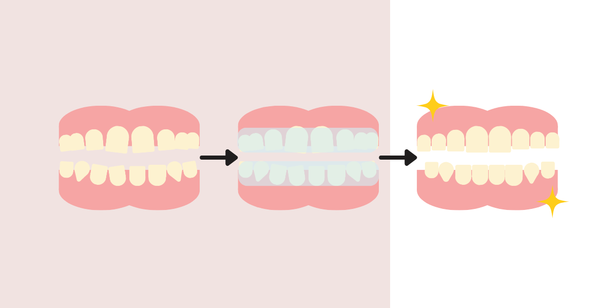 Invisalign: how it works - Blossom Cosmetic Clinic in York