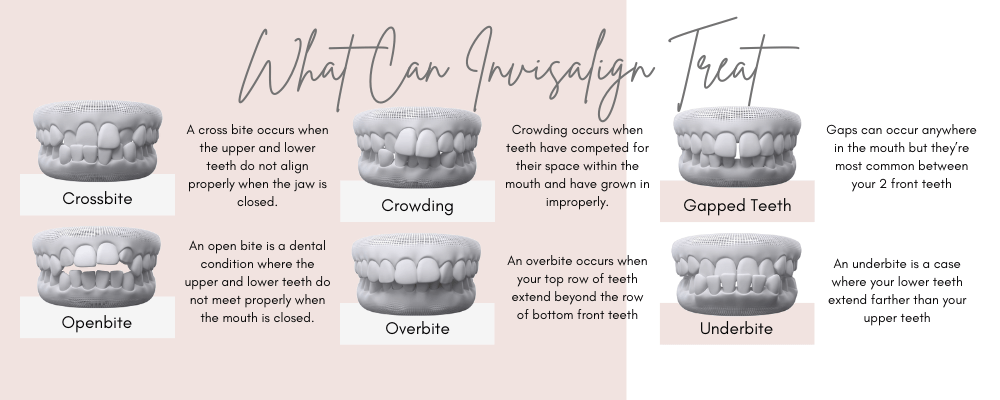 What can invisalign treat graphic Crossbite - occurs when the upper and lower teeth do not align properly when the jaw is closed. Crowding - occurs when teeth have competed for their space within the mouth and have grown improperly. Gapped teeth - occur anywhere in the mouth but most common for 2 front teeth. Openbite - upper and lower teeth do not meet properly when the mouth is closed. Overbite - top row of teeth extend beyond the row of bottom front teeth. Underbite - lower teeth extend farther than your upper teeth. York cosmetic and dental clinic