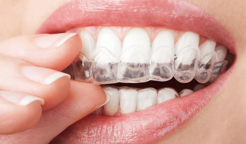 A woman placing the Invisalign guard in her mouth